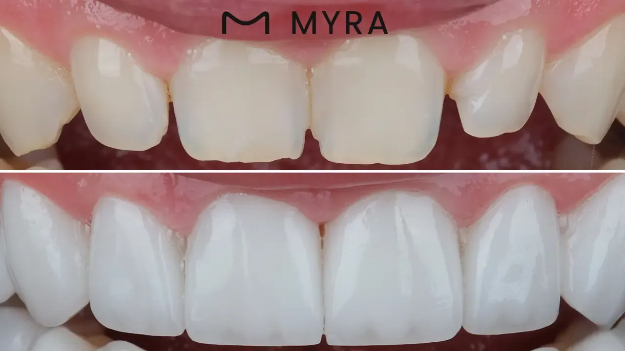 what is enamel shaping?